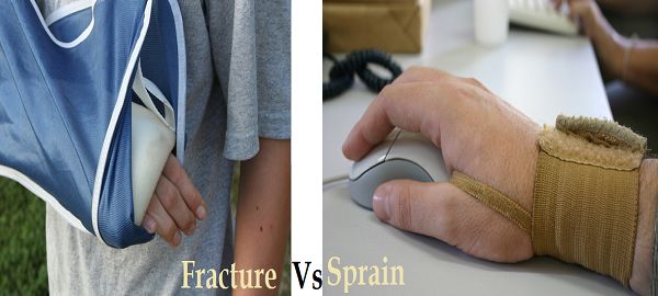 difference between fracture and sprain