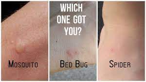 Differences Between Bed Bug Bites and Spider Bites